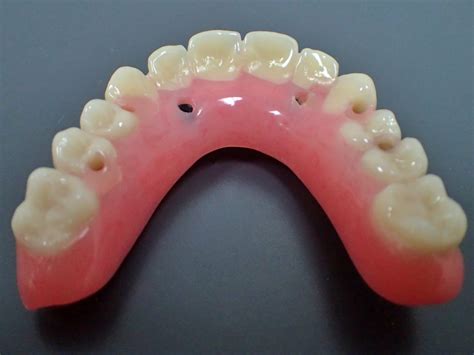 Fixed Implant Retained Hybrid Dentures - ProCare Denture Clinic & Implant Centre in Edmonton ...