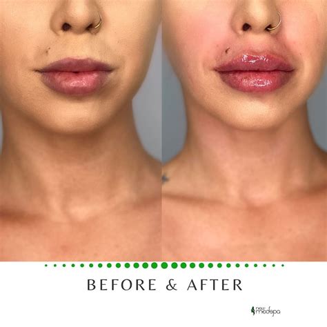 Lip Filler Before and After | Lip fillers cost, Lip fillers, Lip augmentation