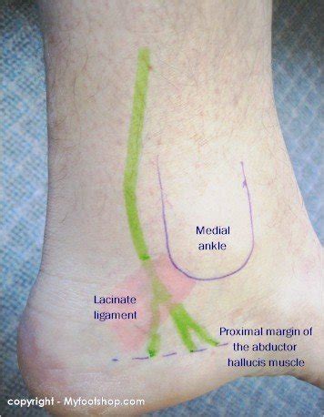 Baxter's Nerve Entrapment | Causes and treatment options | MyFootShop.com