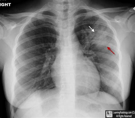 Fundamental Radiological Findings: Air Bronchograms – Stepwards