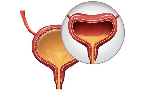 Overactive Bladder - Urology Clinics of North Texas