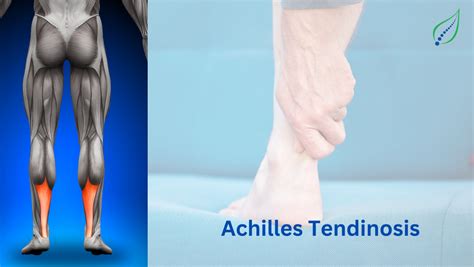 Achilles Tendinosis: Causes, Symptoms, Treatment | Expert Insights ...