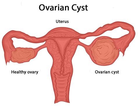 What Causes Ovarian Cysts and How are They Treated?