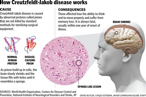 N.H. patients possibly exposed to fatal brain disease - The Boston Globe