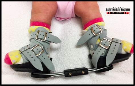 Clubfoot Deformity - FootEducation