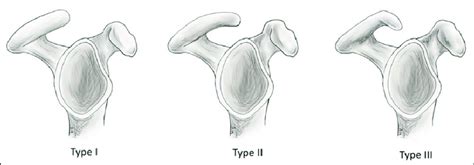 Types Of Acromion Shapes