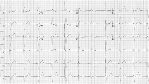 Pacemaker Rhythms – Normal Patterns • LITFL • ECG Library Diagnosis