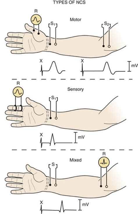 Upper Extremity Nerve Conduction Studies