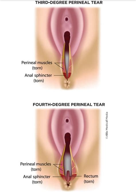 Understanding 3rd Degree Vaginal Tear: Causes, Symptoms, and Treatment