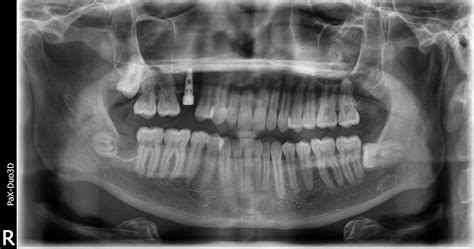 Wisdom Teeth Extraction/Coronectomy With Simultaneous Baby Tooth Dental ...