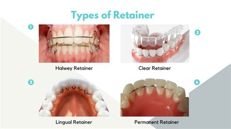 √ Retainer Price and Types in Philippines 2024