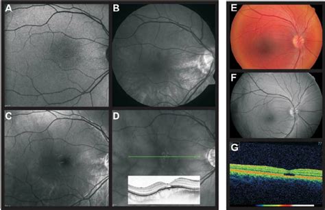 Fundus photography and OCT scans from a 33-year-old woman (CHRO ...