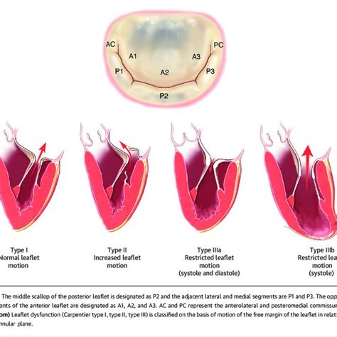 Grading the Severity of Primary Mitral Regurgitation by... | Download Table