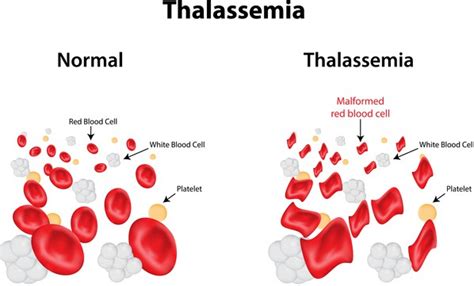 What is MCH blood test and What does it mean - Laboratoryinfo.com