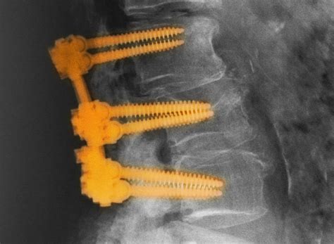 Bone Quality Linked to Complications After Spinal Fusion - Endocrinology Advisor