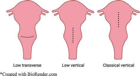 Cesarean Section Incision Types