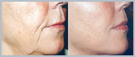 Sculptra North New Jersey | Facial Injections Rutherford, NJ