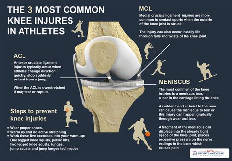 The 3 most common knee injuries in athletes | Cruciate ligament, Anterior cruciate ligament ...