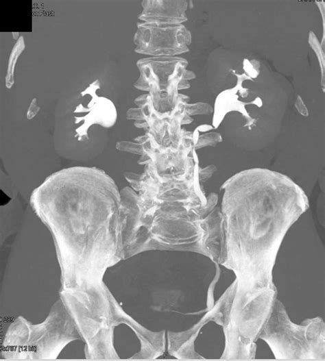 Stent in Right Renal Artery for Treatment of Renal Artery Aneurysm ...