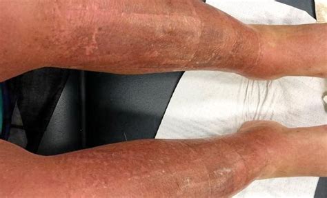 Woman suffers third degree burns from the sun | Fraser Coast Chronicle