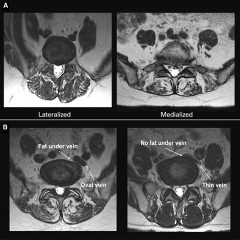 Chart of axial CT images demonstrating facet arthropathy grading as... | Download Scientific Diagram