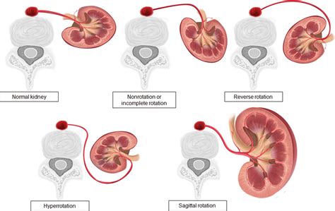 Congenital Anomalies of the Upper Urinary Tract: A Comprehensive Review ...