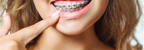 The Pros and Cons of Traditional Metal Braces – Oxnard Gentle Dentistry