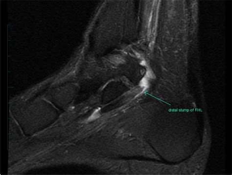 FHL Tendonitis & Injuries - Foot & Ankle - Orthobullets