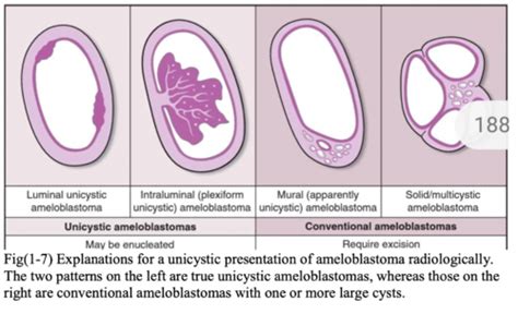 Unicystic Ameloblastoma Histology