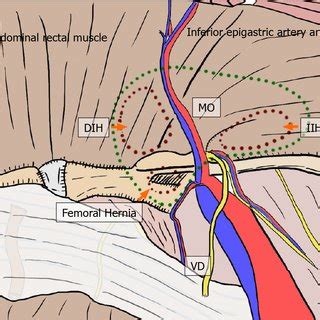 History of anatomy and surgery for groin hernia | Download Scientific ...