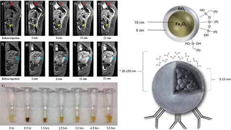 High-quality MRI at lower-cost : Superparamagnetic iron oxide nanoparticles (SPIONs) as a ...