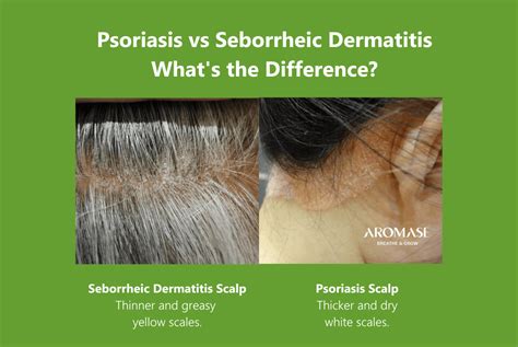 Seborrheic Dermatitis Shampoo, Psoriasis Shampoo,, 58% OFF