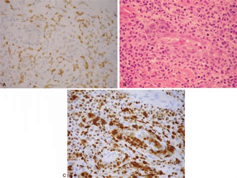 (A) CD3 stain (note the smaller tumor cells are diffusely positive for... | Download Scientific ...