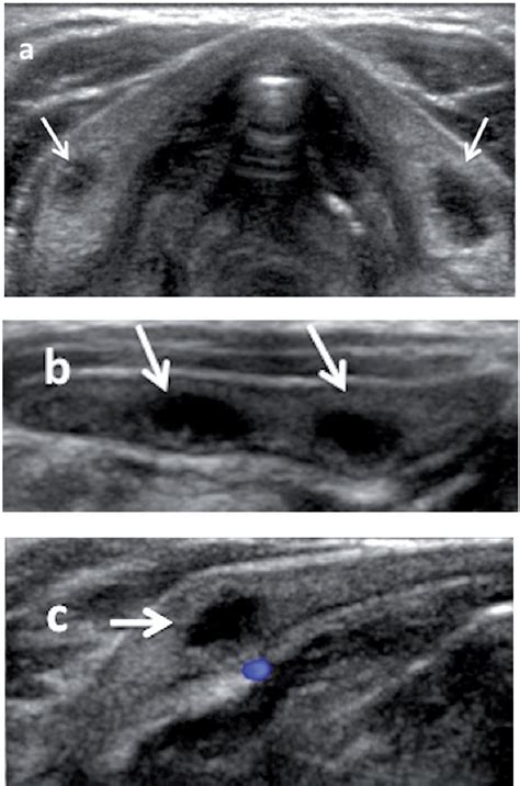 Cyst-like change in the thyroid cartilage: A developmental variant in children | Semantic Scholar