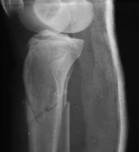 Proximal tibia fracture | Image | Radiopaedia.org