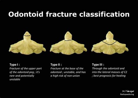 Odontoid fracture classification: diagram | Radiology Case | Radiopaedia.org | Radiology ...