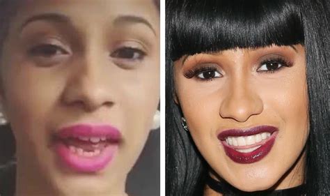 Did Cardi B Get Her Teeth Fixed? See Before-and-After Pictures