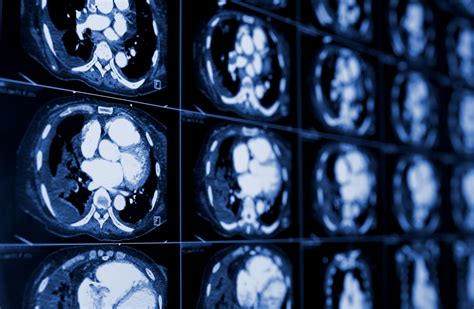 Low-Dose CT Scan for Lung Cancer Screening