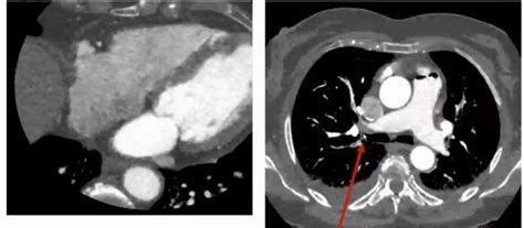 Chest CT images with contrast; computed tomography angiography (CTA)... | Download Scientific ...