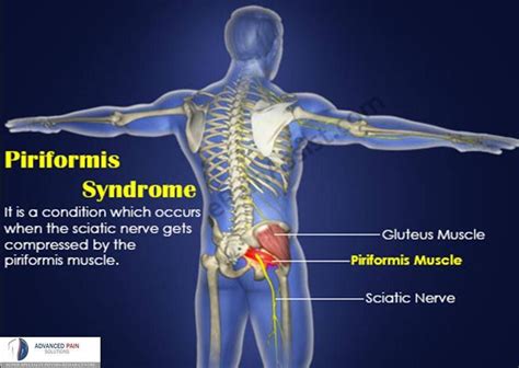 Piriformis Syndrome | Piriformis syndrome, Sciatica treatment, Piriformis