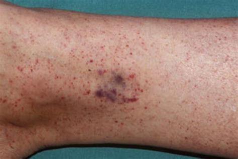 Petechiae Pictures, Causes, Symptoms, Diagnosis and Treatment ...