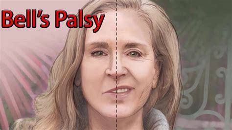 Bell's Palsy - Facial Nerve palsy - YouTube