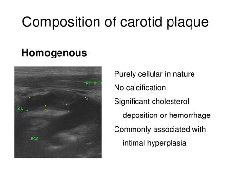 Quantification of ica stenosis(정혜선) 20110331