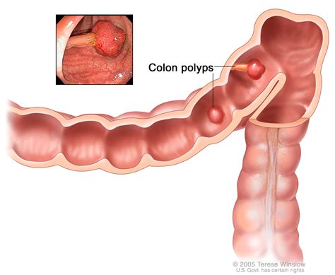 Colorectal Cancer Diagnosis and Treatment | Knight Cancer Institute | OHSU