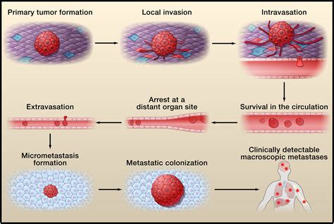 Tumor Metastasis: Molecular Insights and Evolving Paradigms: Cell