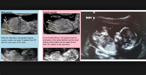 Gender reveal at 12 week scan. | BabyCenter