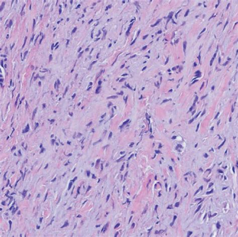 (a) Biopsy of the parotid gland revealed a neoplasm comprised of ...