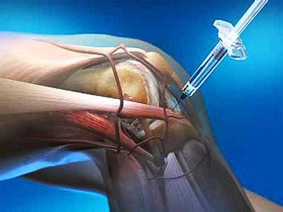 Knee Injections - Pain management clinics in Las Vegas | Nevada ...