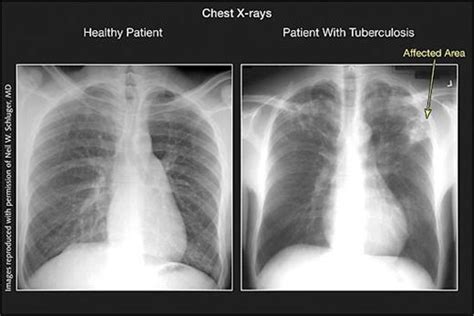 Tuberculosis | Infectious Diseases | JAMA | JAMA Network