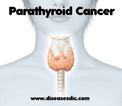 Parathyroid Cancer- Symptoms, Diagnosis and Treatment